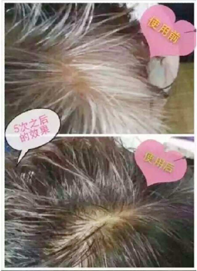 头道汤头皮清净液使用效果