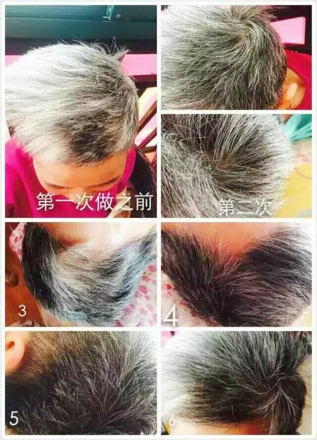 头道汤头皮清净液使用效果