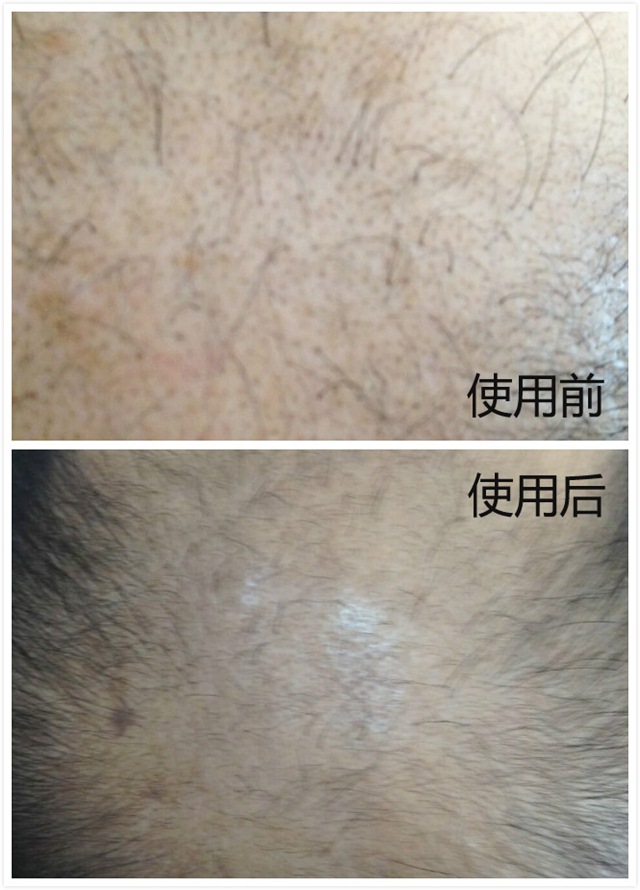 头道汤头皮清净液使用效果