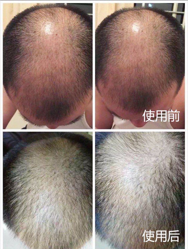 头道汤头皮清净液使用效果