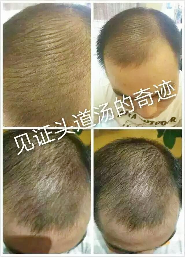 头道汤头皮清净液使用效果