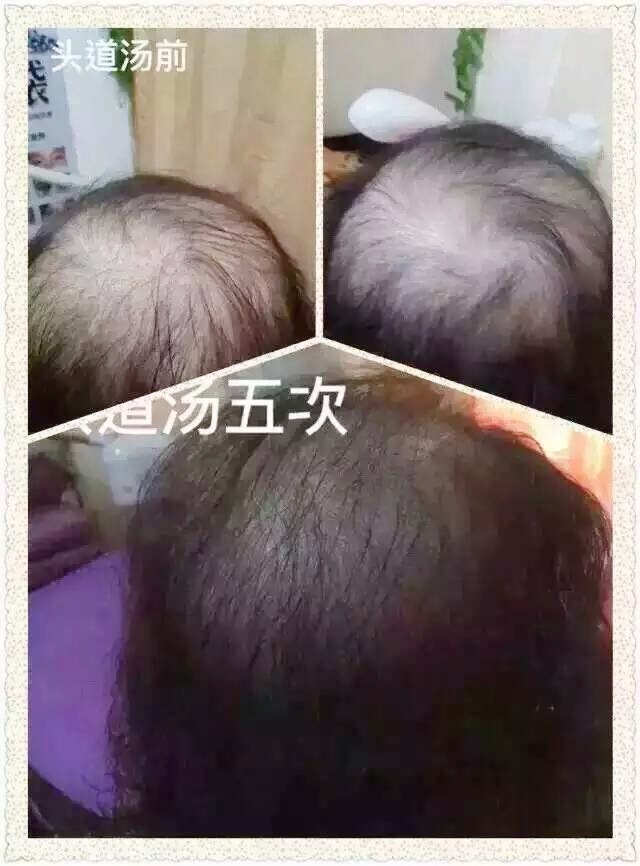 头道汤头皮清净液使用效果