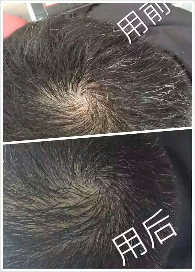 头道汤头皮清净液使用效果